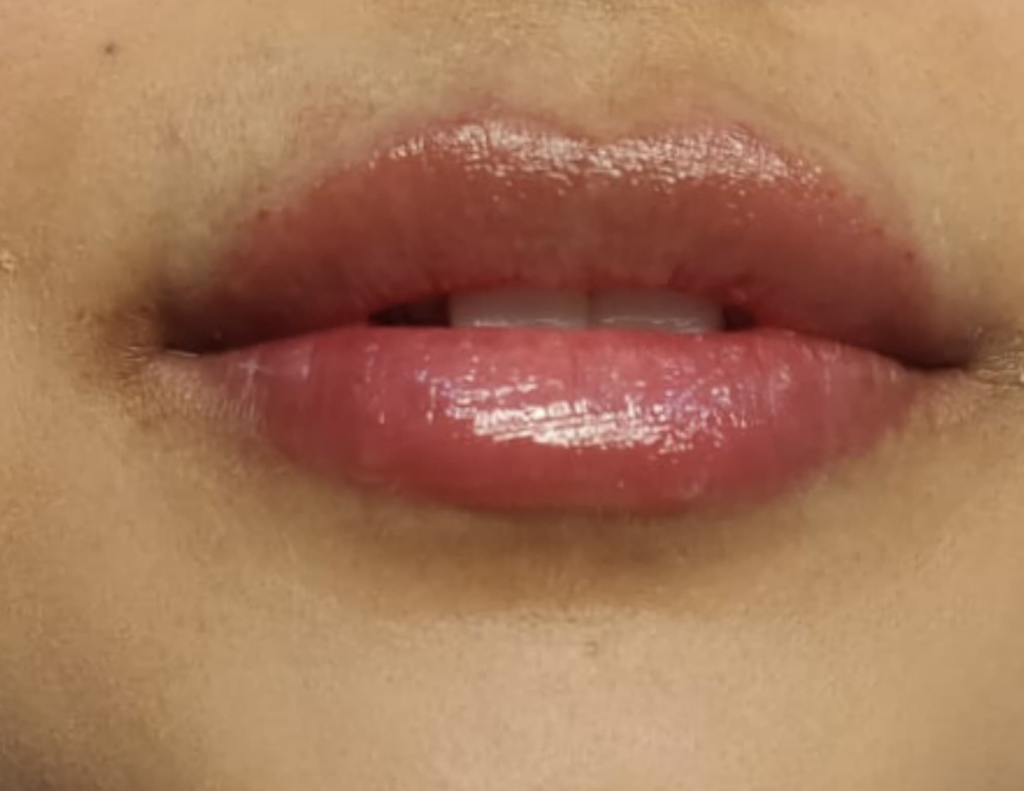 After Lip Filler Augmentation