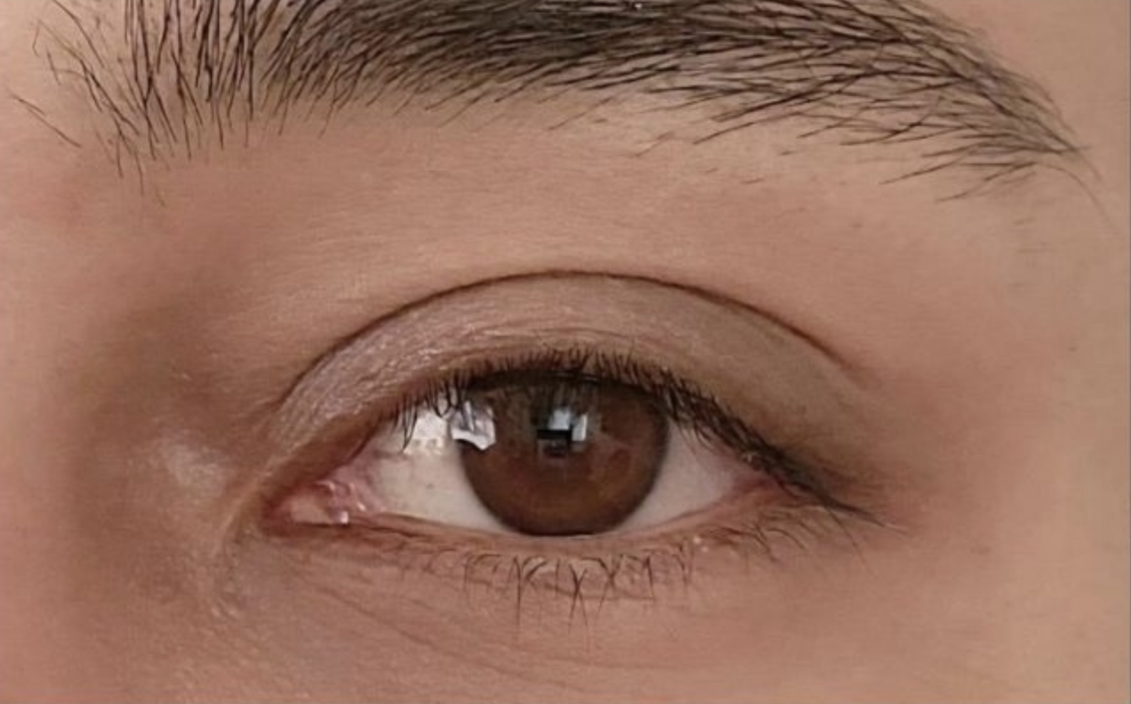 After Under Eye Salmon DNA