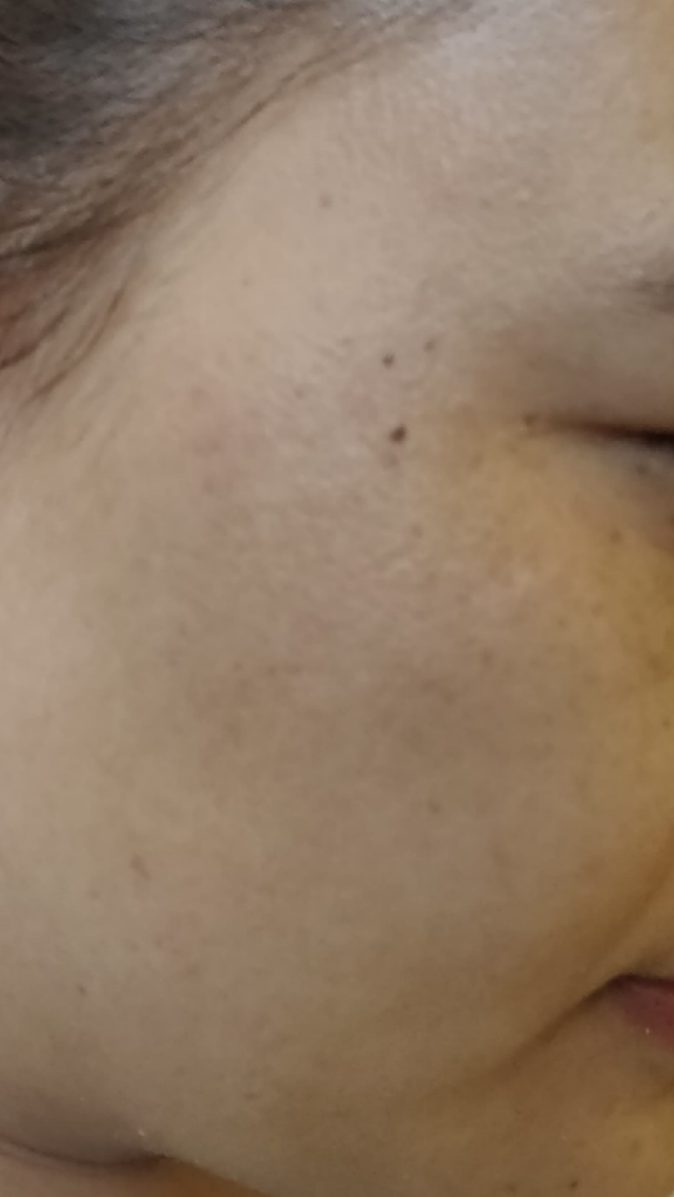 After Melasma Treatment