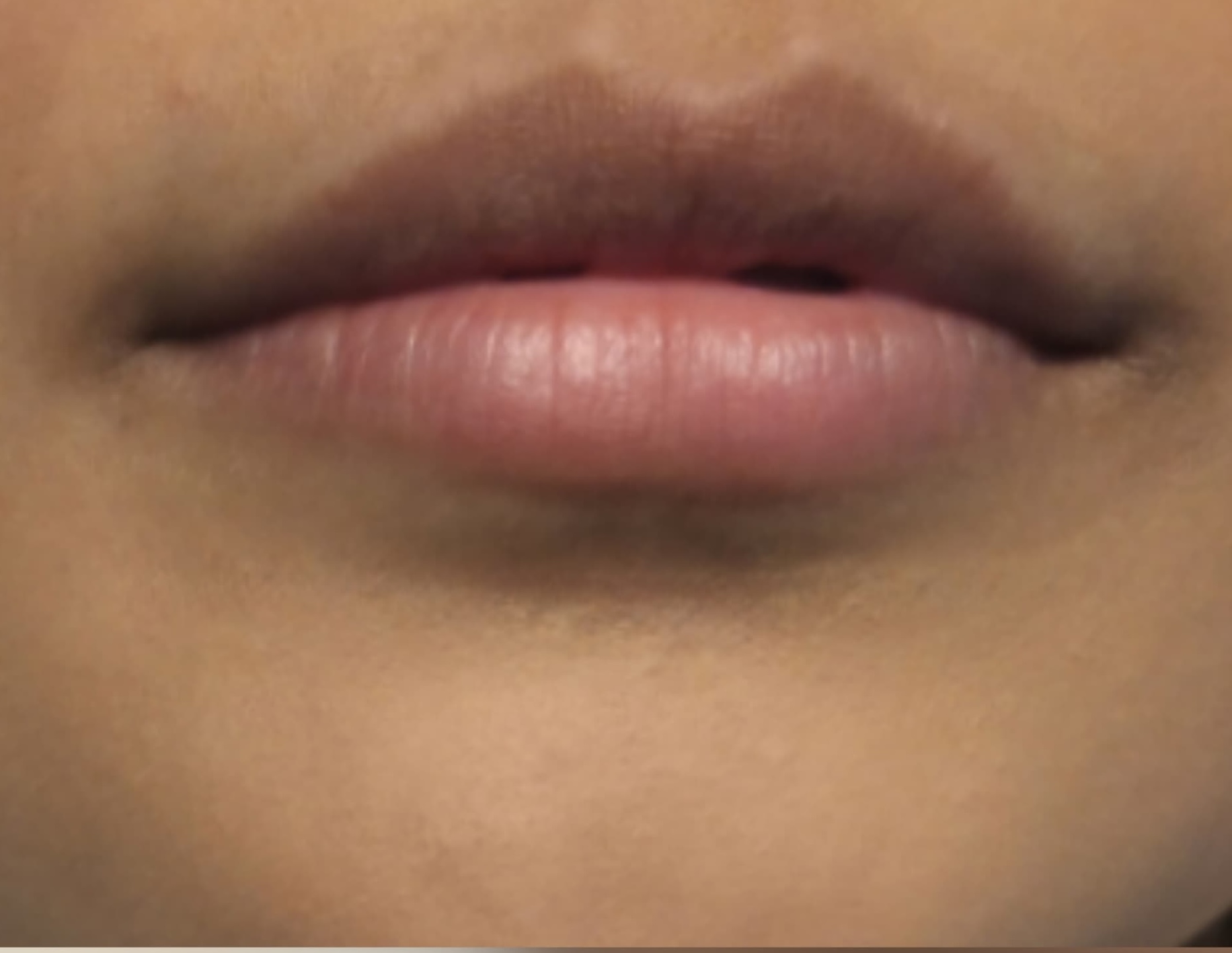 Before Lip Filler Augmentation
