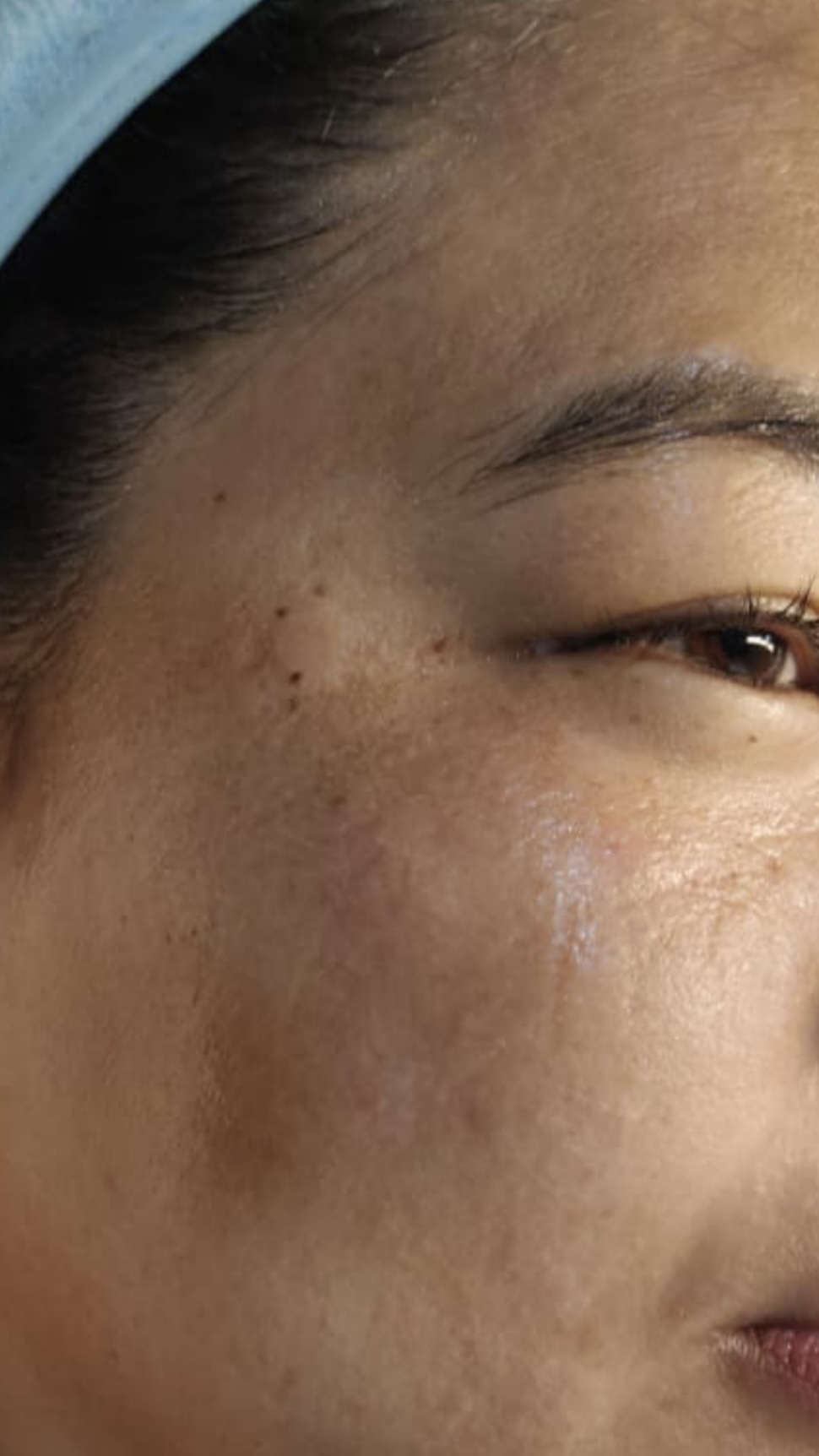 Before Melasma Treatment